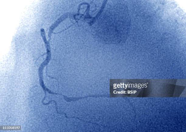 Myocardial Infarction. Stenosed Right Coronary Artery By Atheromatous Plaques. Visualization Through An Angiography With Injection Of A Contrast...