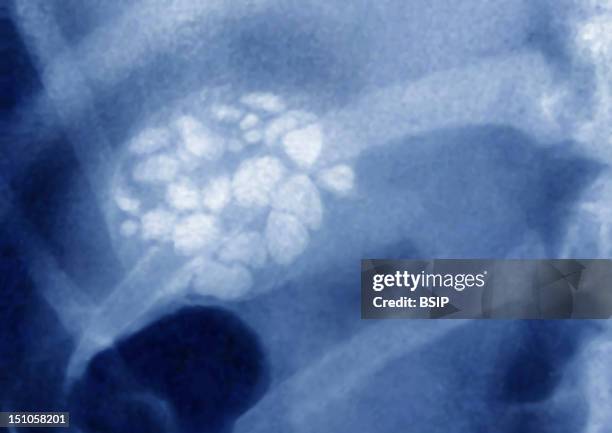 Lithiasis Bladder Stones Photos and Premium High Res Pictures - Getty Images