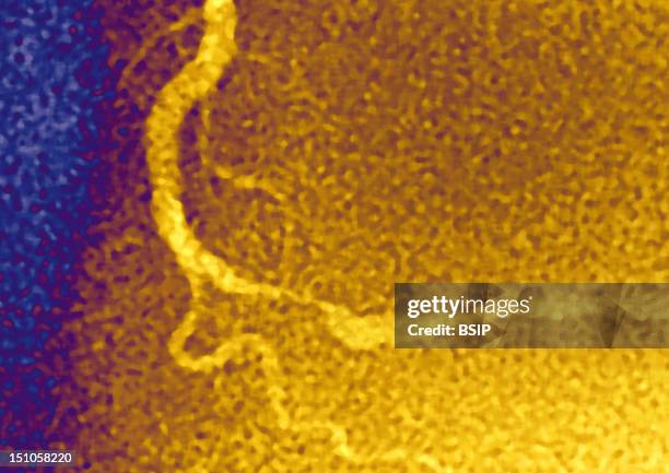 Myocardial Infarction. Stenosed Right Coronary Artery By Atheromatous Plaques. Visualization Through An Angiography With Injection Of A Contrast...