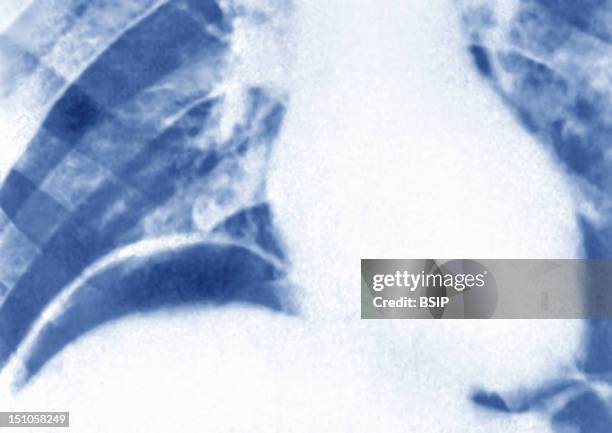 Pneumoperitoneum Consecutive To A Perforated Gastric Ulcer. Thoracic X Ray In Front View. Pneumoperitoneum Is A Gaseous Effusion In The Peritoneal...