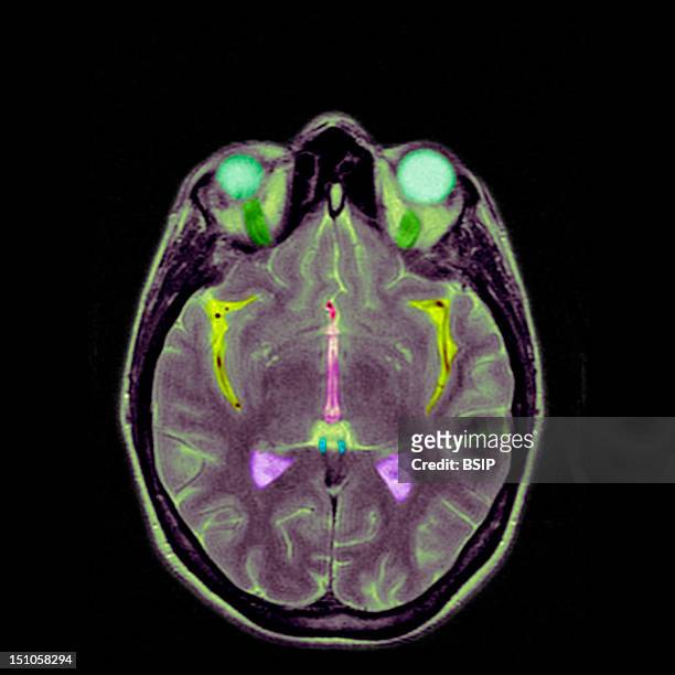 Cross Section. Cf. Image 0209706 For The Numbers. 1. Eyeballs2. Optic Nerves. 3. Anterior Cerebral Vein. 4. Sulcus Lateralus Called Of Sylvius. 5....