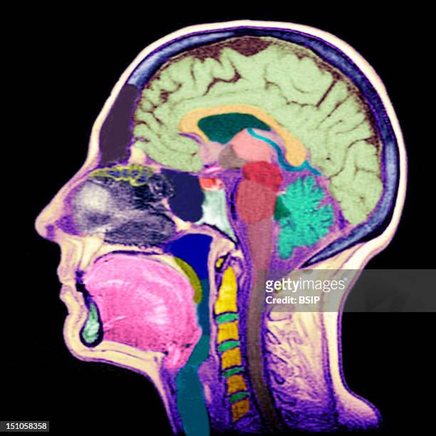 Sagittal Section. Cf. Image 0212106 For The Numbers. 1. Brain. 2. Corpus Callosum Splenium. 3. Septum Lucidum. 4. Thalamus. 5. Mamillary Body. 6....