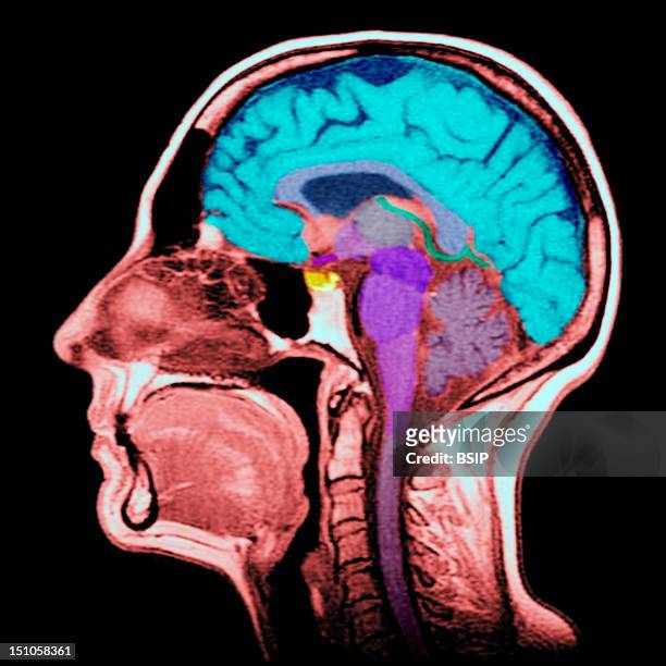Sagittal Section. Cf. Image 0212106 For The Numbers1. Brain. 2. Corpus Callosum Splenium. 3. Septum Lucidum. 4. Thalamus. 5. Mamillary Body. 6....