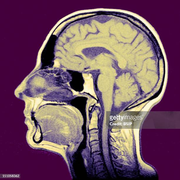 Sagittal Section. Cf. Image 0212106 For The Numbers1. Brain. 2. Corpus Callosum Splenium. 3. Septum Lucidum. 4. Thalamus. 5. Mamillary Body. 6....
