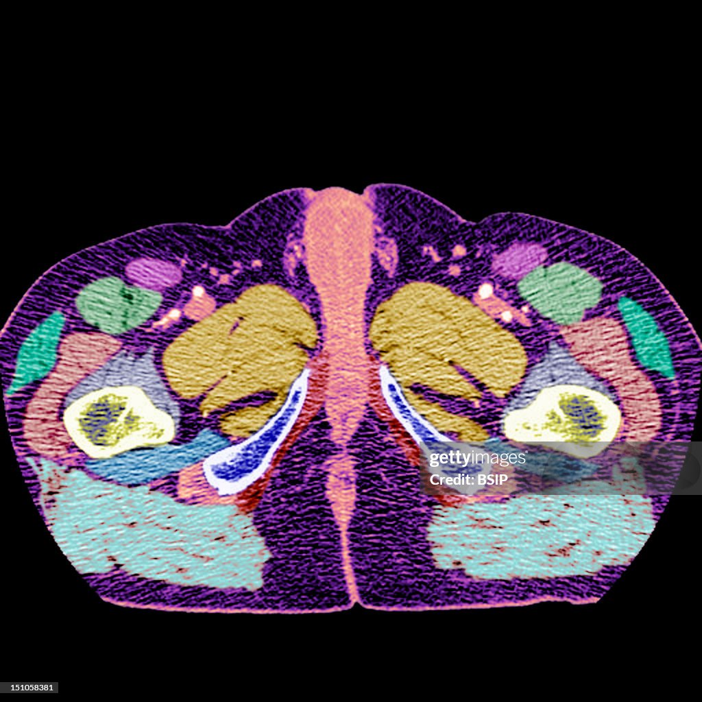 Male Perineum, Scan