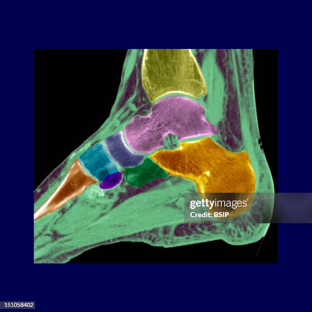 Tibia Scan Tibia (Instrument) Photos and Premium High Res Pictures - Getty Images