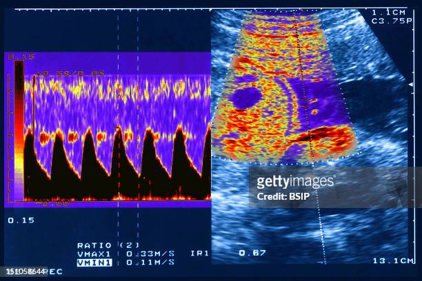 Doppler Ultrasound Examination Of Placental Vascular Resistance In Woman At Fifth Month Of Pregnancy.