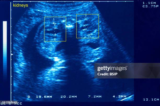 Measure And Examination Of Kidneys Of A 5 Month Old Fetus. Axial View.