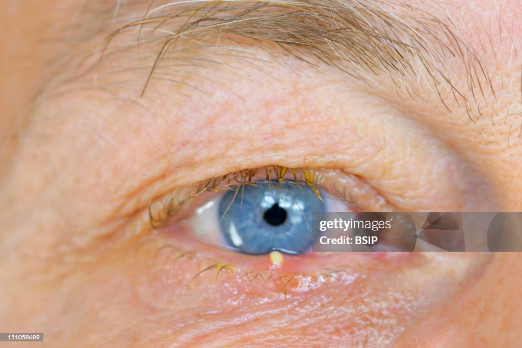 Stye Romycin Stye News Photo - Getty Images
