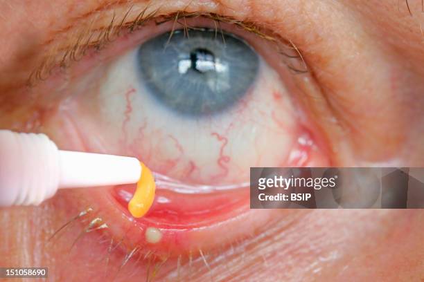 Application Of A Mercury Oxide Ointment Antiseptic To Treat Stye.