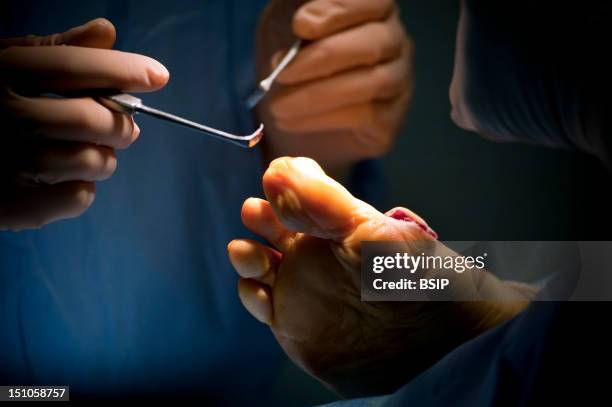 Photo Essay At Alleray Labrouste Clinic, Paris, France. Surgery Of A Hallux Valgus.