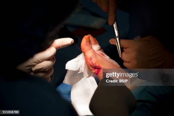 Photo Essay At Alleray Labrouste Clinic, Paris, France. Surgery Of A Hallux Valgus. Suture Of A Wound.