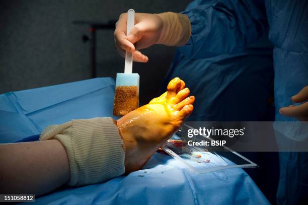 Photo Essay At Alleray Labrouste Clinic, Paris, France. Surgery Of A Hallux Valgus.
