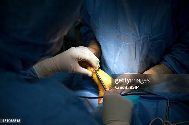 Photo Essay At Alleray Labrouste Clinic, Paris, France. Surgery Of A Hallux Valgus. Incision With An Electrocautery Device.