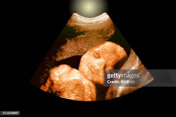 Fetus, At Approximately 30 Weeks. Frontal View Of Face.