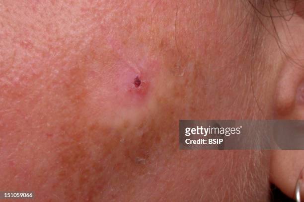 Bowenoid Actinic Keratosis And Focus Of A Superficial Basal Cell Carcinoma.