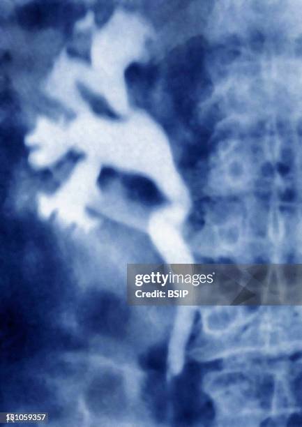 Nephritic Colic Distension Of The Renal Pelvis And Calyxes By Accumulation Of The Urine During The Obstruction Of The Ureter By A Lithiasis,...