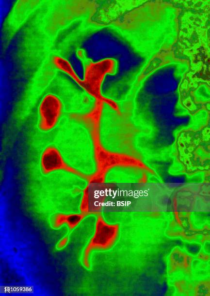 Polycystic Kidney, Visualized By Urography, Right Kidney In Front View.