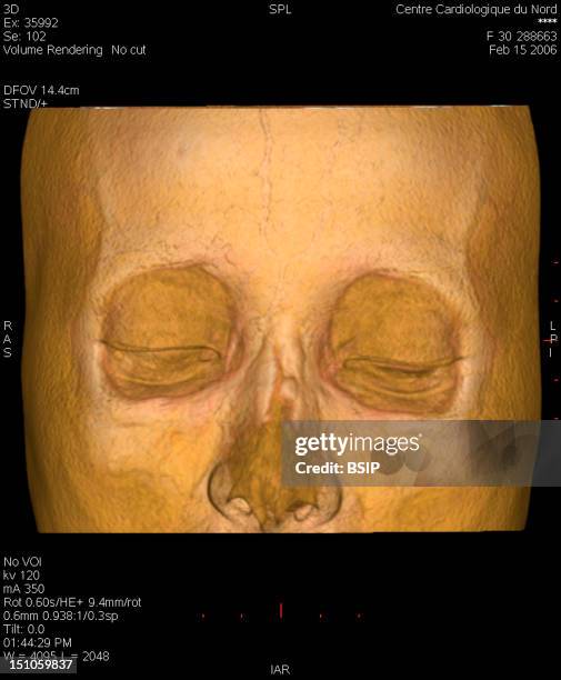 Scanner Of The Facial Massif. Intermediary Thresholding Perceiving The Orbital Outlines And The Bones Specific To The Nose. Woman With A Fracture Of...