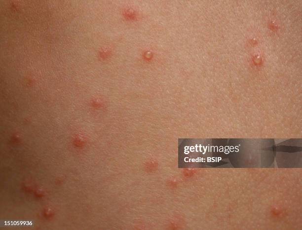 Chickenpox Mild Rash Mild Chicken Pox Pictures Early Stages