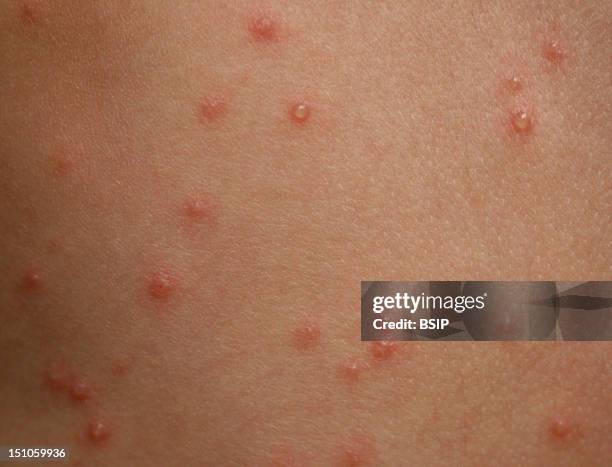 Chickenpox On A 4 Year Old Child 1St Day.