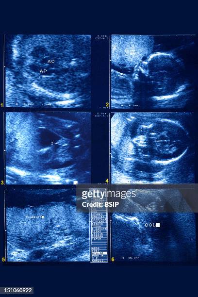 Ultrasound During Fifth Month. 1 Examination Of Heart, Pulmonary Artery, And Aorta. Axial View. 2 Examination Of Skull. Sagittal View. 3...