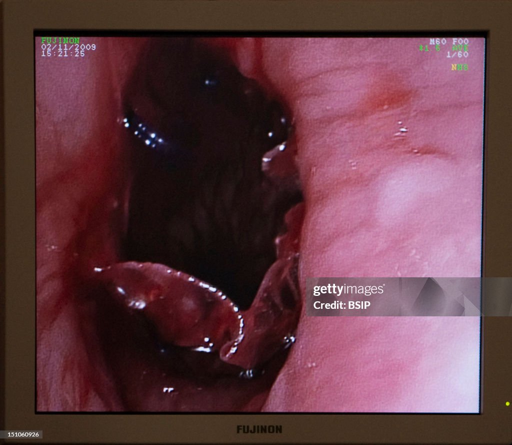 Esophageal Prosthesis Surgery