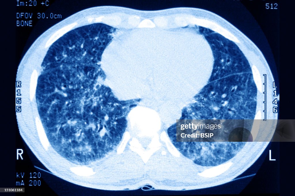 Sarcoidosis Scanner