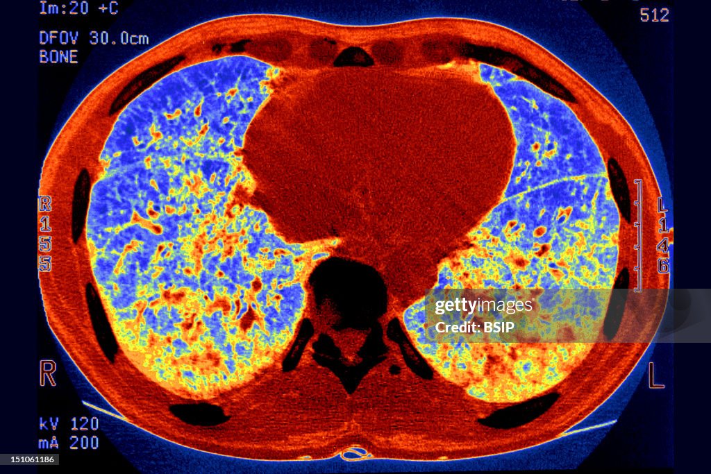Sarcoidosis Scanner