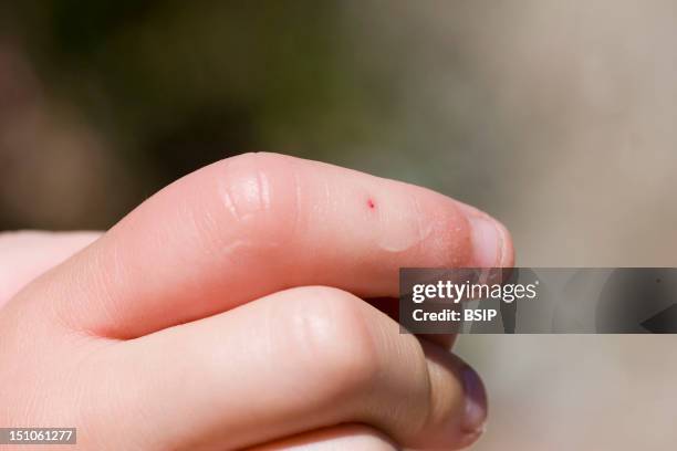 Insect Bite