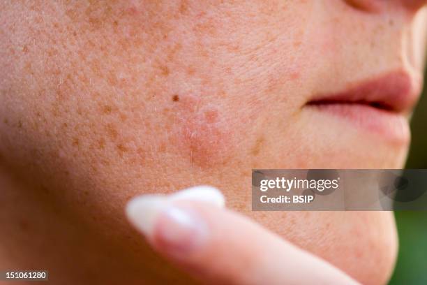 Antiviral Cream For The Treatment Of Labial Herpes Vesicles On The Cheek.