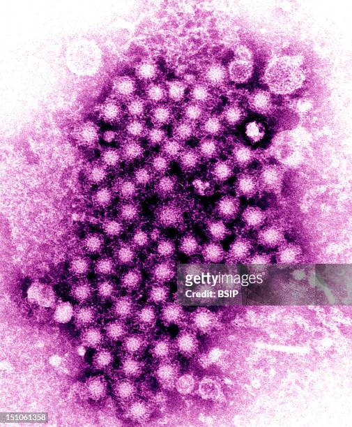 Hepatitis Virus Colorized Tem. The Type Of Hepatitis Virus Is Unknown. This Transmission Electron Micrograph Tem Revealed Numerous Hepatitis Virions,...