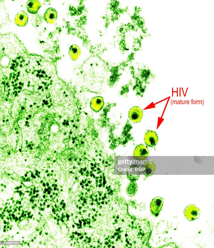 Aids Virus Infection, Tem