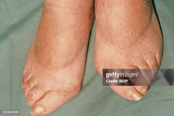 Aschleroderma Scleroderma Illness Photos and Premium High Res Pictures - Getty Images
