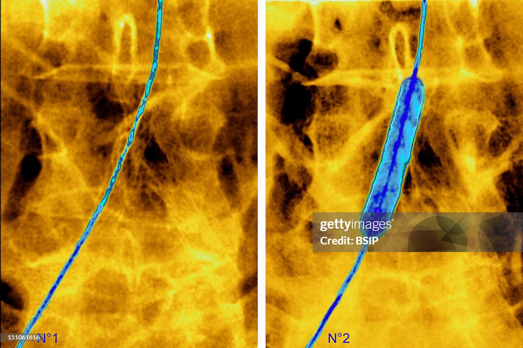 Arterial Angioplasty, Result