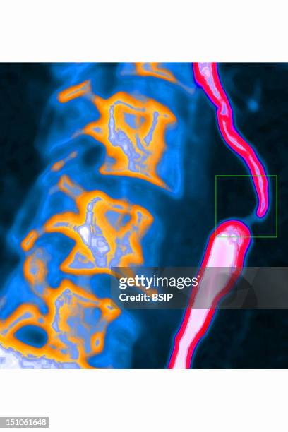 Carotid Thrombosis. This Disorder Often Leads To Cerebrovascular Accidents. Sagittal Neck Angiogram.