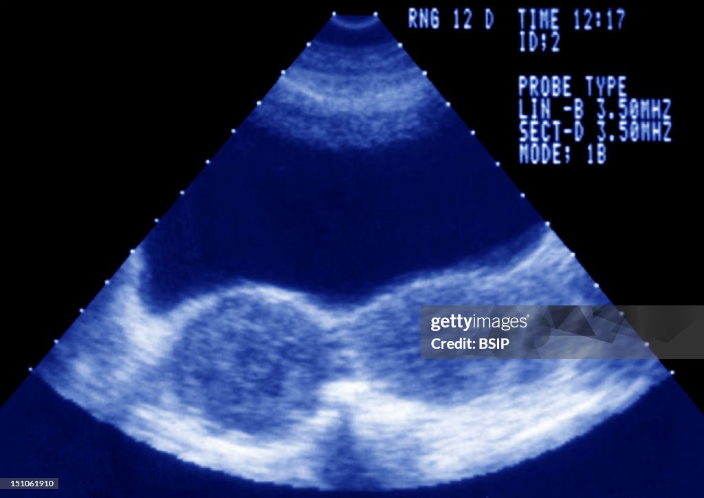 Uterus, Cyst