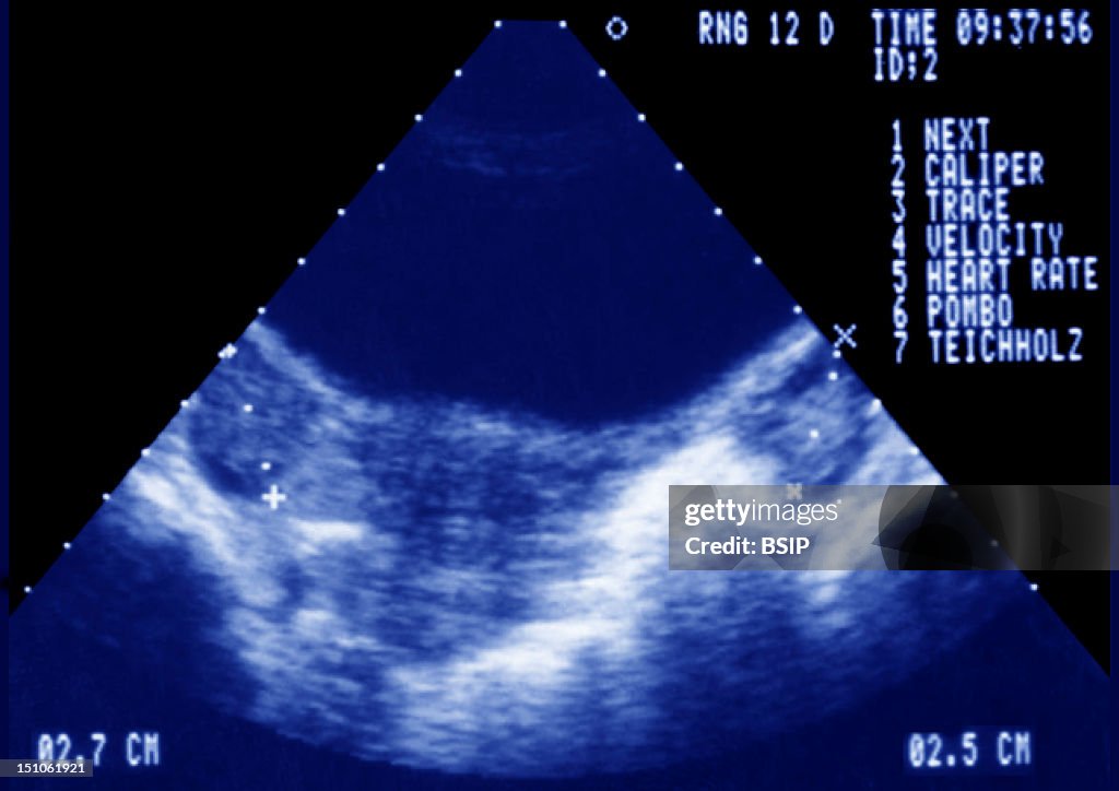Polycystic Ovary Syndrome