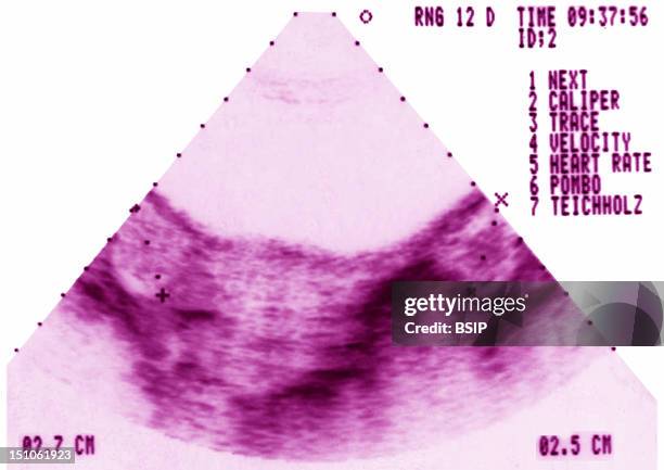 Gynecological Ultrasound. Ovarian Dystrophy.