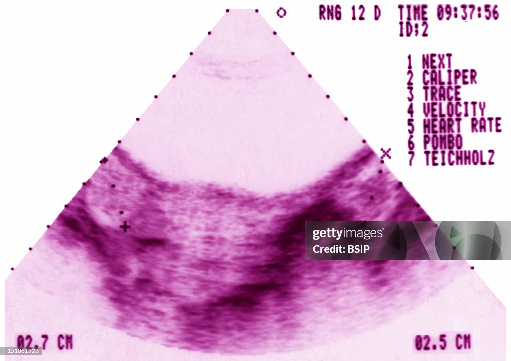 Polycystic Ovary Syndrome