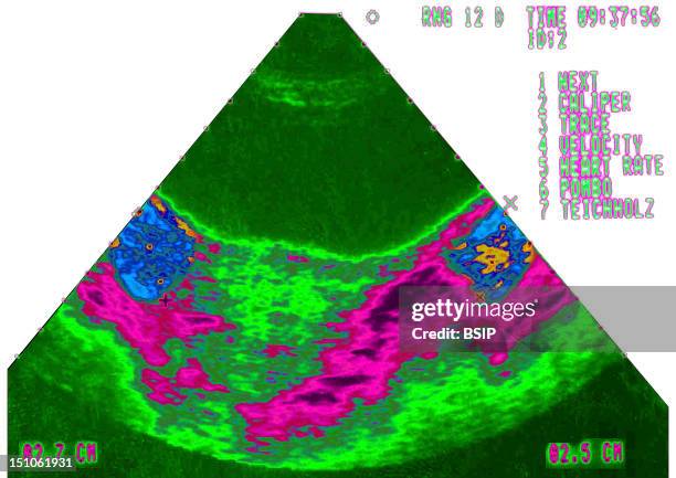 Gynecological Ultrasound. Ovarian Dystrophy.