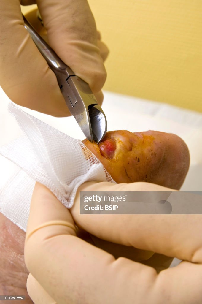 Diabetic Foot Care