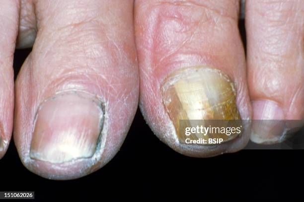 Onychomycosis