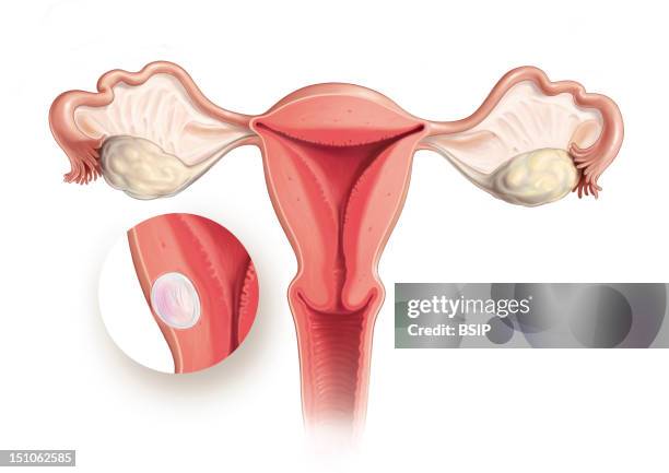 Subserous Uterine Fibroma Of The Uterus Body. The Uterine Fibroma Is A Benign Tumor Developped From The Uterus Muscle Myometrium. It Is A...