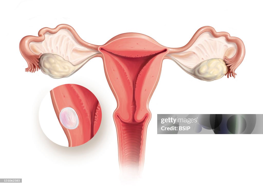 Uterine Fibroma, Drawing