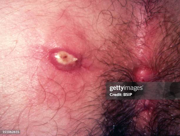 Perianal Abscess.