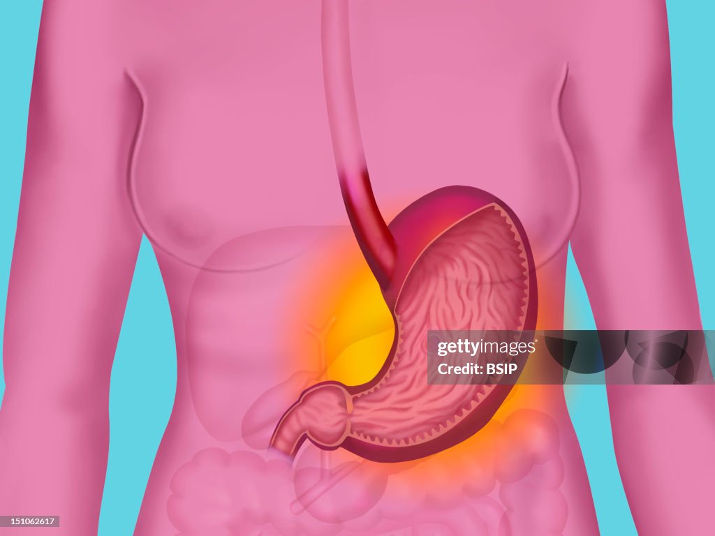 Gastric Ulcer, Drawing