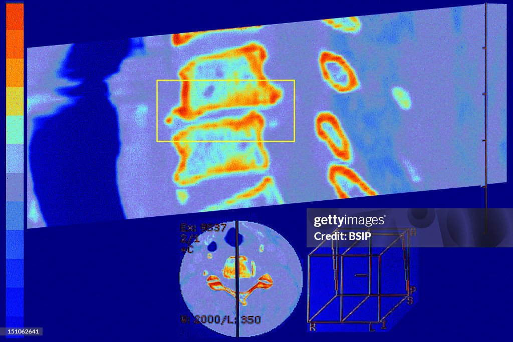 Cervical Osteoarthritis, Mri