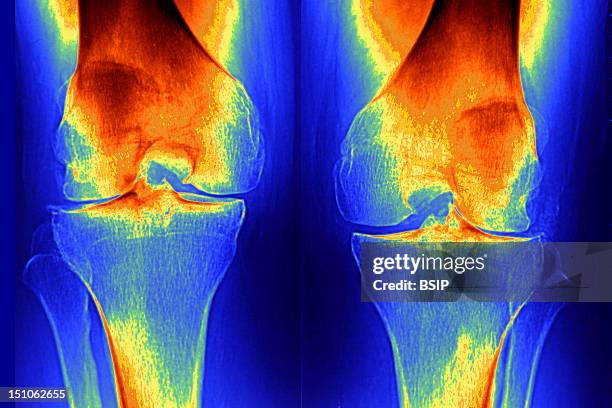 Front Rise Knee 922 Knee Joint Front View Stock Photos, High-Res Pictures, and Images ...