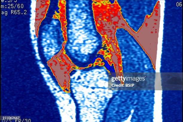 Hydrarthrosis. Mri, Sagittal View.